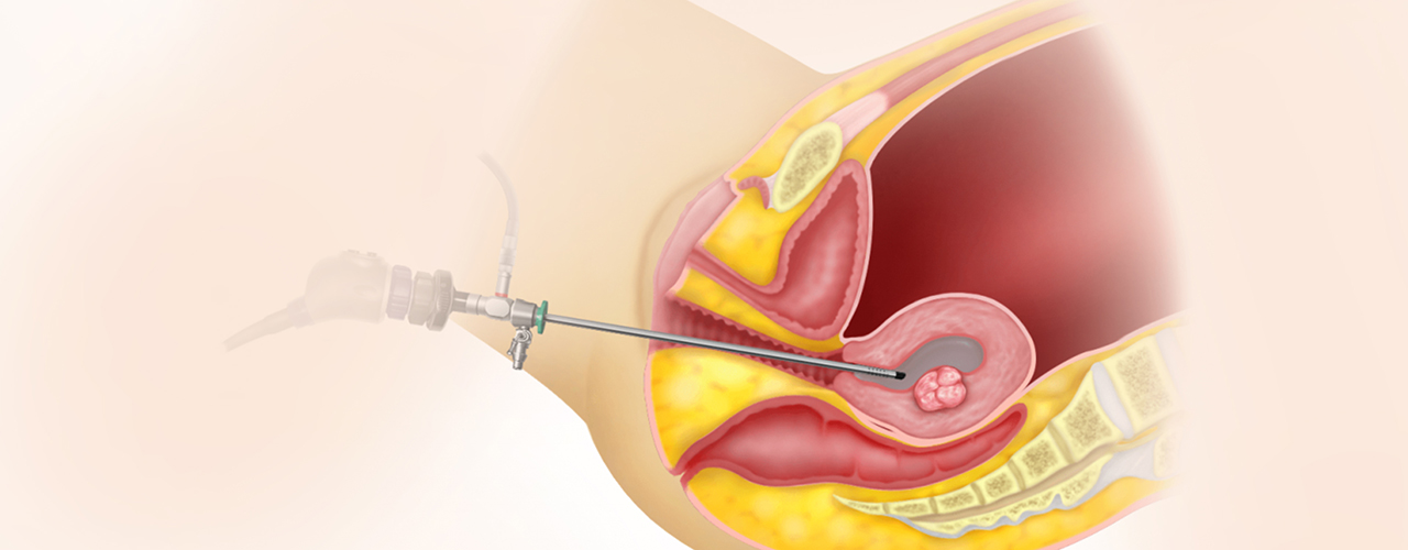 hysteroscopy in ivf